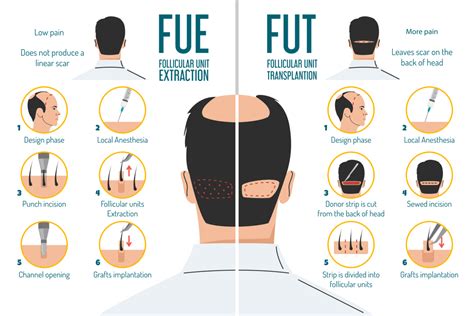 Haartransplantatie Vergelijking: FUE Vs. FUT Methodes