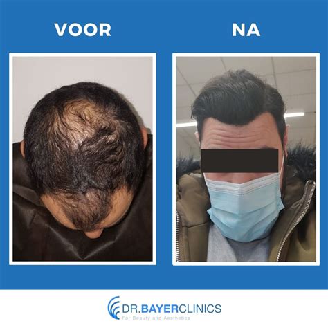 Haartransplantatie Voor En Na Foto’s: Inspiratie En Vooruitzichten