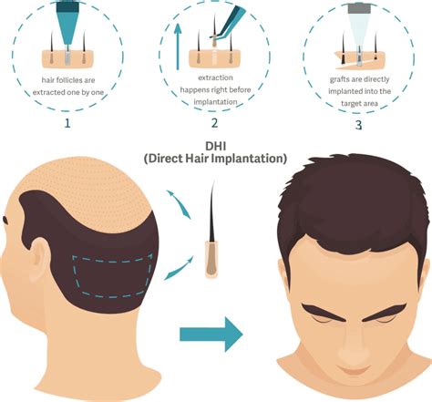 De Belangrijke Rol Van DHI Bij Haartransplantaties