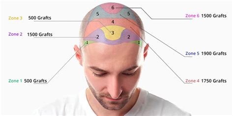 Haartransplantatie En Bijbehorende Kosten: Wat Is Normaal?