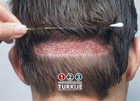 Haartransplantatie Mythes: Wat Is Waar?