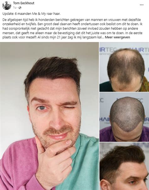 De Juiste Levensstijl Voor Succesvolle Haartransplantatie