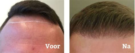 Zorg En Onderhoud Na Een Haartransplantatie