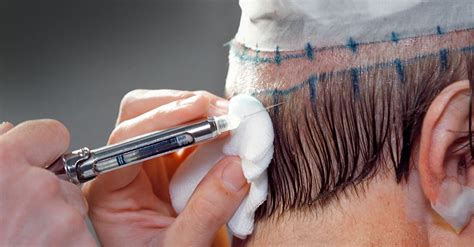 De Toekomst Van Haartransplantaties