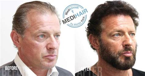 Haartransplantatie En Medische Voorwaarden: Wat Te Weten