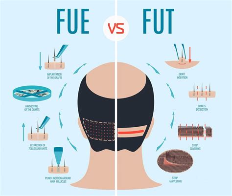 DHI Vs. FUE: Welke Haartransplantatiemethode Is Geschikt Voor Jou?