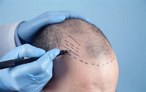 Hoe Werkt Een Saffier FUE Haartransplantatie?