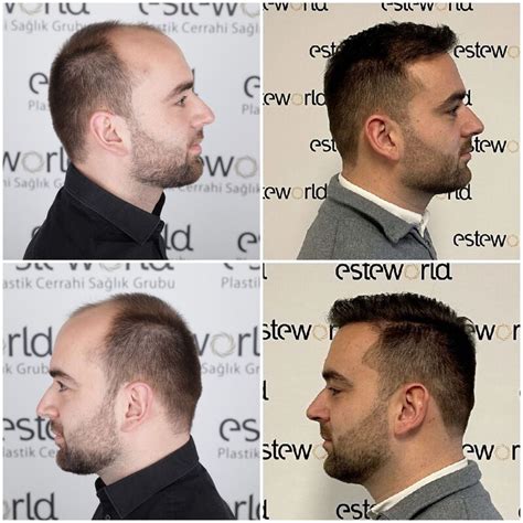 Van Kaalheid Naar Een Volle Haardos: Mijn Ervaring Met Haartransplantatie